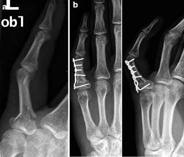 icd 10 open fracture right hand