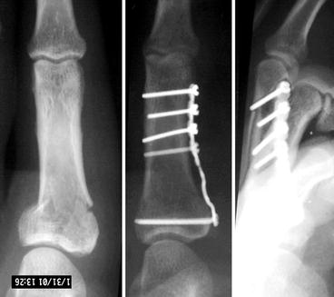 fracture distal phalanx left lesser toe icd 10