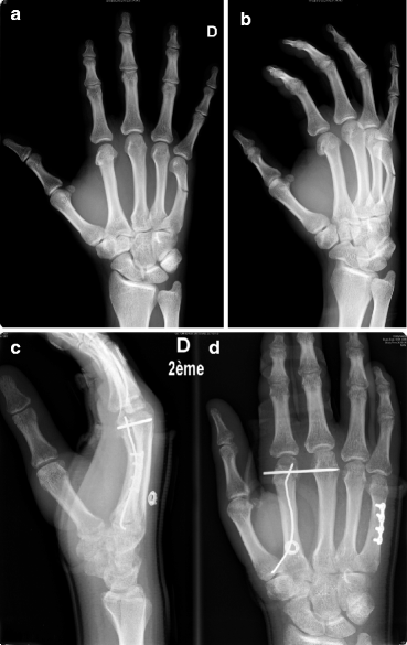 What is a Finger Fracture & How to Handle Such Injuries? - Upswing Health