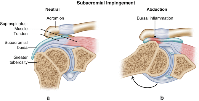 The rotator cable extends from lesser tubercle of humerus to greater