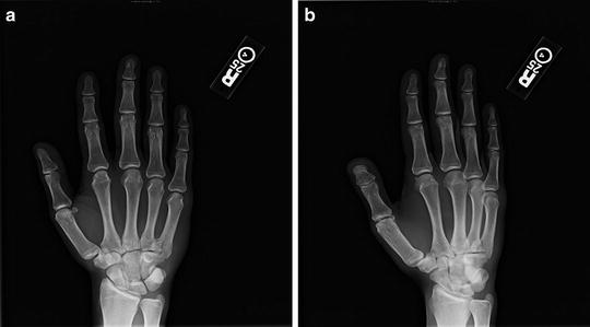 Acute Upper Extremity Injuries in Pediatric and Adolescent Sports ...