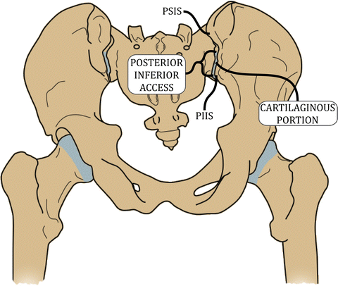 Posterior Inferior Approach, Minimally Invasive | Musculoskeletal Key