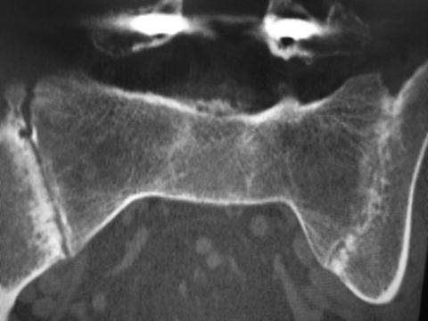 sacroiliac arthrosis kezelési fóruma