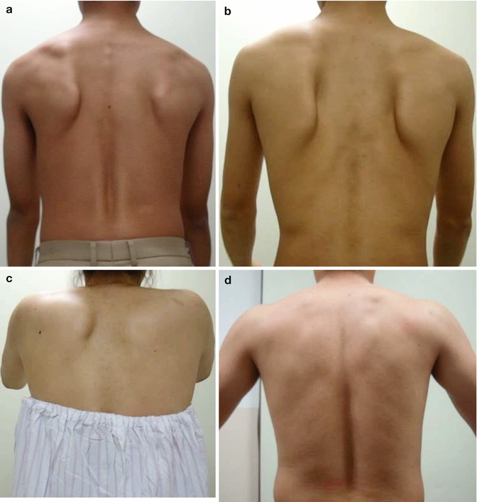 Scapular Dyskinesis Part II. A New Diagnostic Modality Three