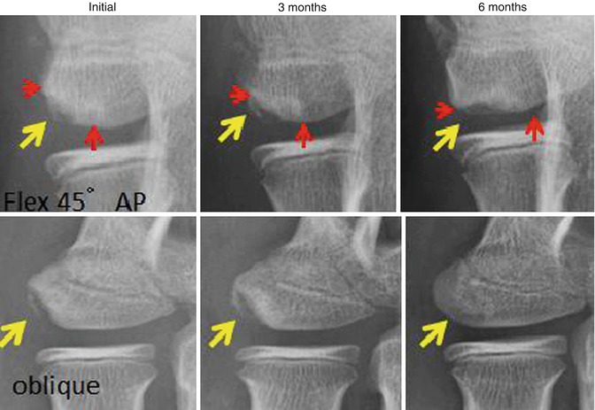 osteochondritis dissecans stages