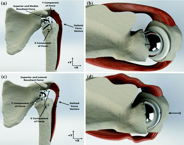 RSA with Glenoid Bone Loss | Musculoskeletal Key