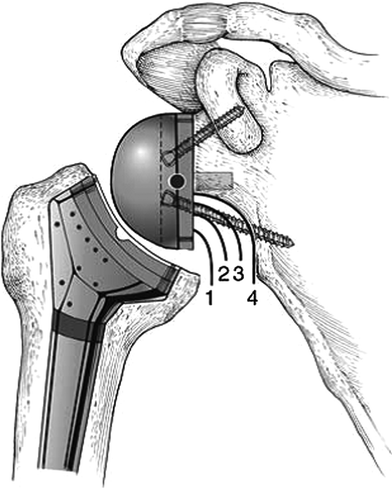 Complications Associated with RSA | Musculoskeletal Key