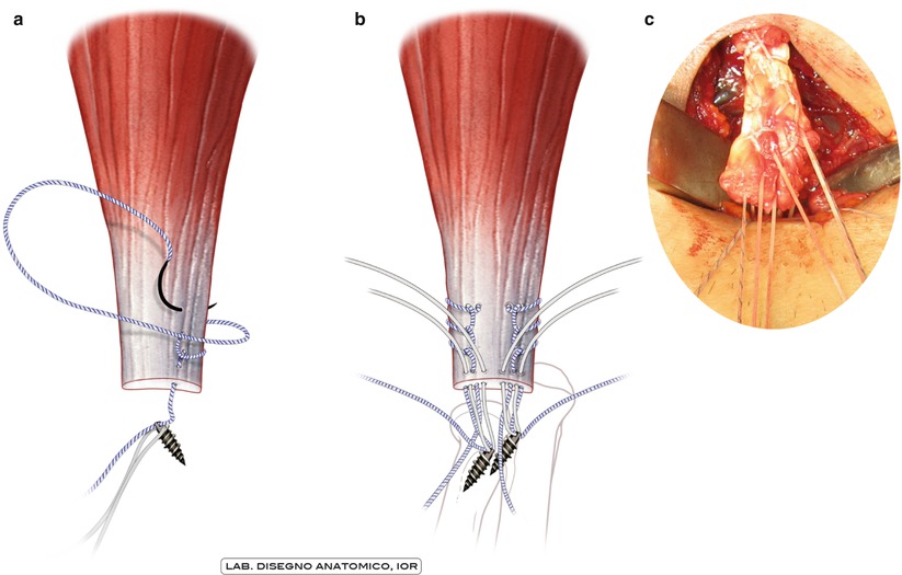 Biceps and Triceps Tendon Lesions | Musculoskeletal Key