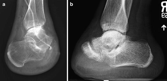 Chopart s Amputation for Osteomyelitis of the Midfoot