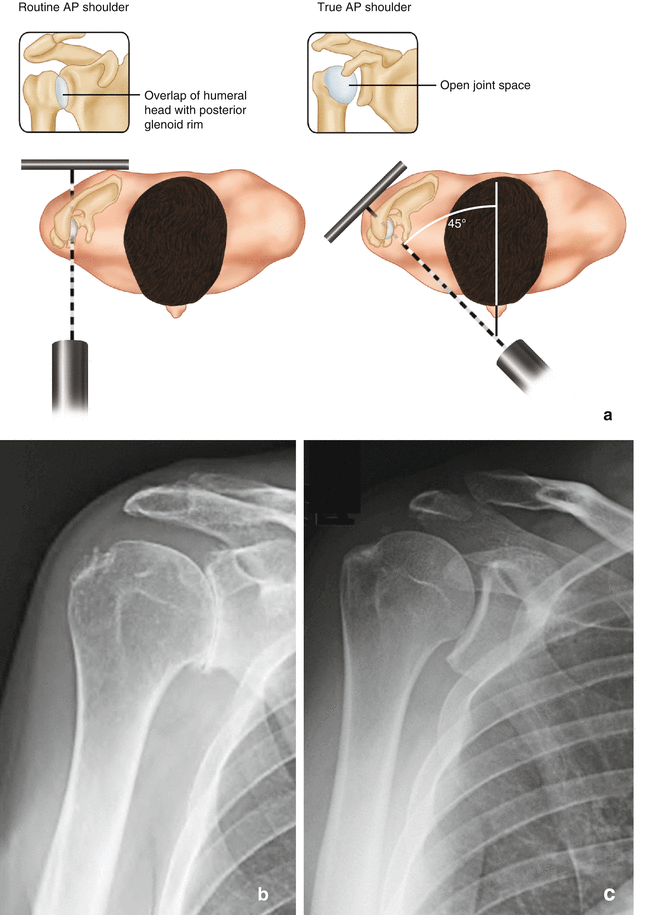 Subacromial Space | Musculoskeletal Key