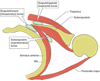 subcoracoid bursitis