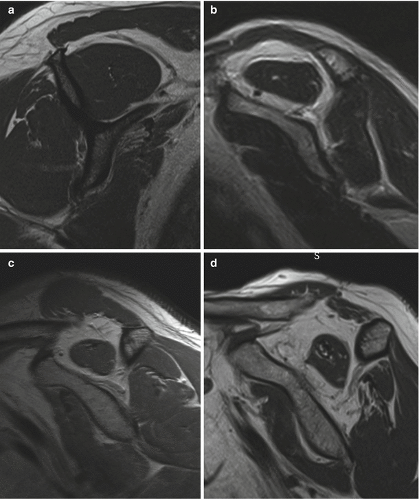 Rotator Cuff Pathology: A Comparison Of Magnetic Resonance Imaging And ...