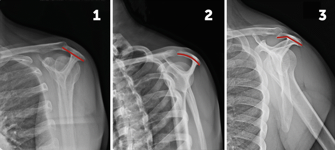 acromion-and-coracoacromial-arch-musculoskeletal-key