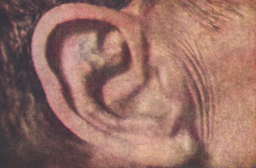 ochronosis ear