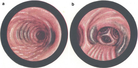 ochronosis ear