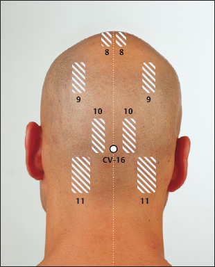 7 Chinese Scalp Acupuncture.