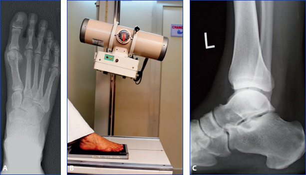 Caudal foot placement superior to toe elevation for navicular  palmaroproximal‐palmarodistal‐oblique image quality - Peeters - 2023 -  Equine Veterinary Journal - Wiley Online Library