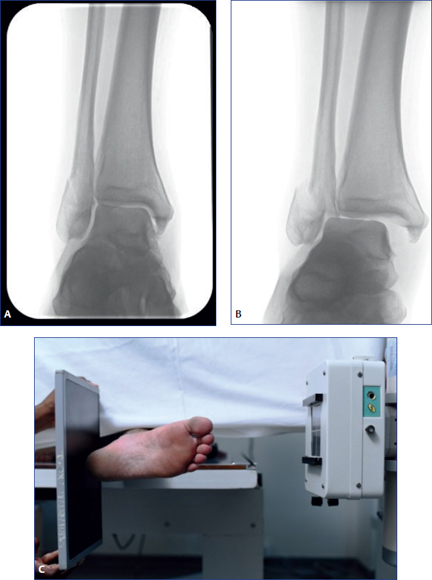 Acute Fractures and Dislocations of the Ankle and Foot in Children