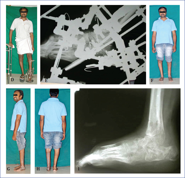 Deformity Correction: Foot And Ankle | Musculoskeletal Key