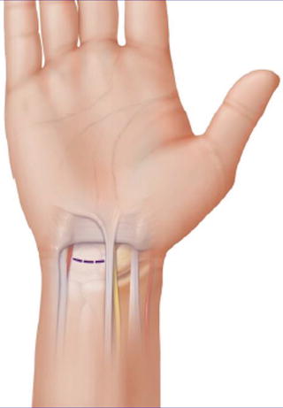 Endoscopic Carpal Tunnel Release | Musculoskeletal Key