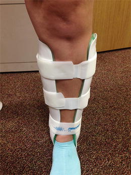 General Treatment Concepts for Stress Fractures | Musculoskeletal Key