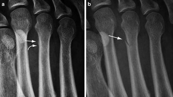 Imaging of Stress Fractures | Musculoskeletal Key