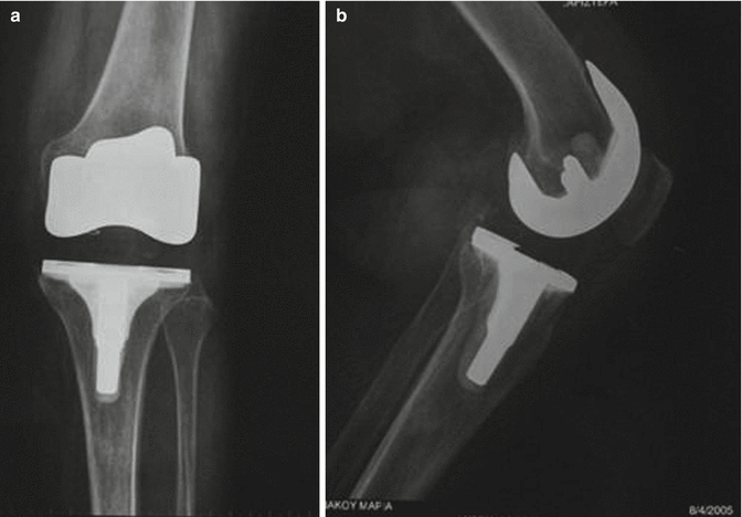 Long Term Clinical of Total Knee Arthroplasty. The