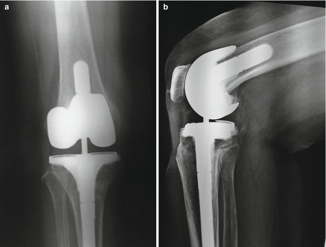 Long Term of Total Knee Arthroplasty. Condylar