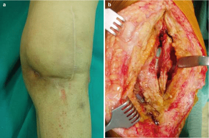 Infected Total Knee Arthroplasty. Basic Science