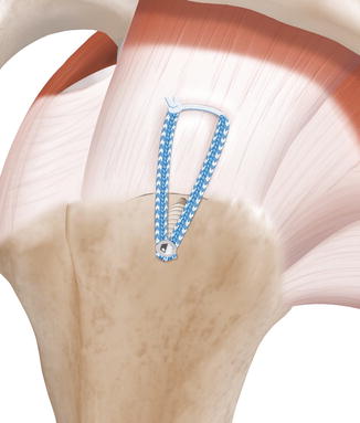 Tips for the Key Surgeries | Musculoskeletal Key