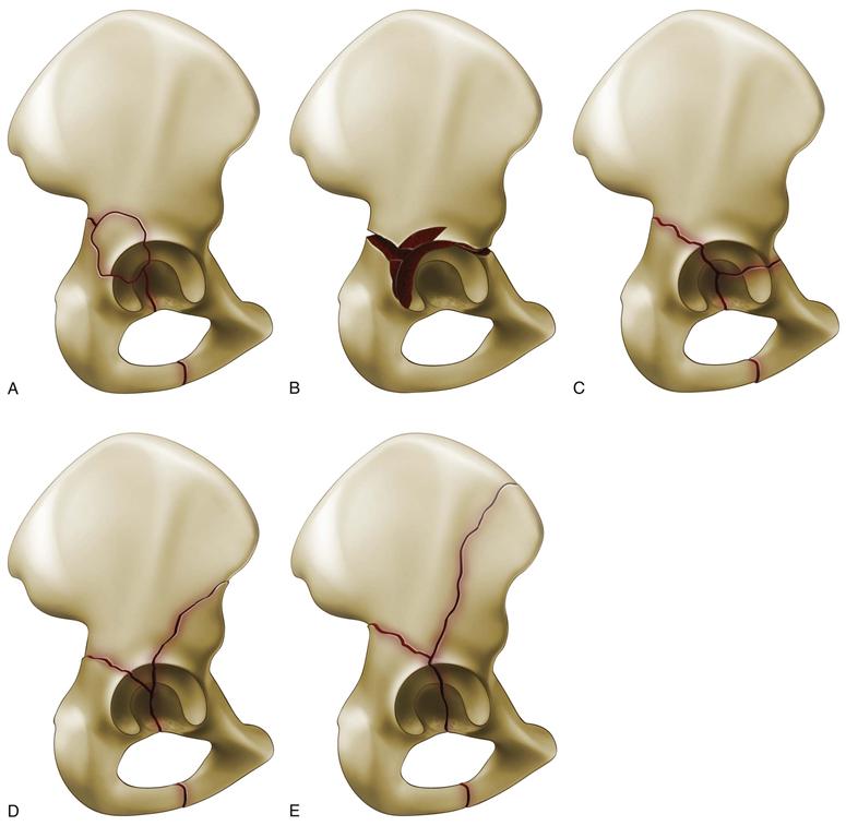 Acetabular Fracture | Musculoskeletal Key