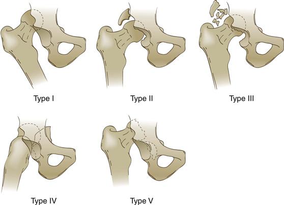 Hip Dislocation and Femoral Head Fractures | Musculoskeletal Key