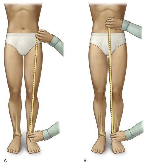 One leg longer than the other? Leg length discrepancy test and