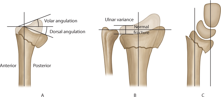 dorsal angulation distal radius fracture