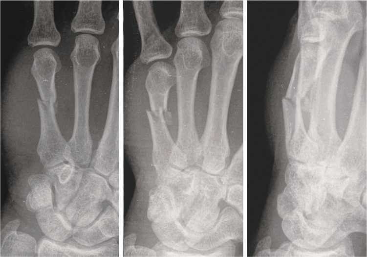 acute oblique fracture