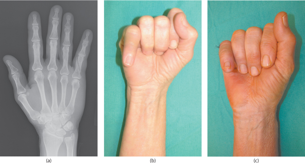 distal phalanx fracture