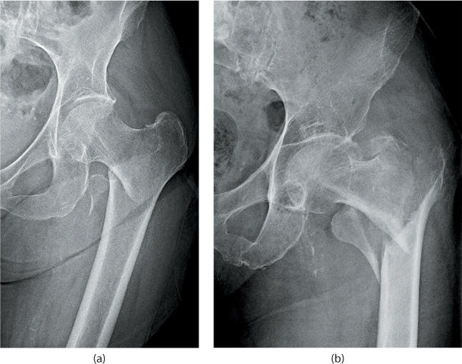 Extracapsular proximal femur fractures | Musculoskeletal Key