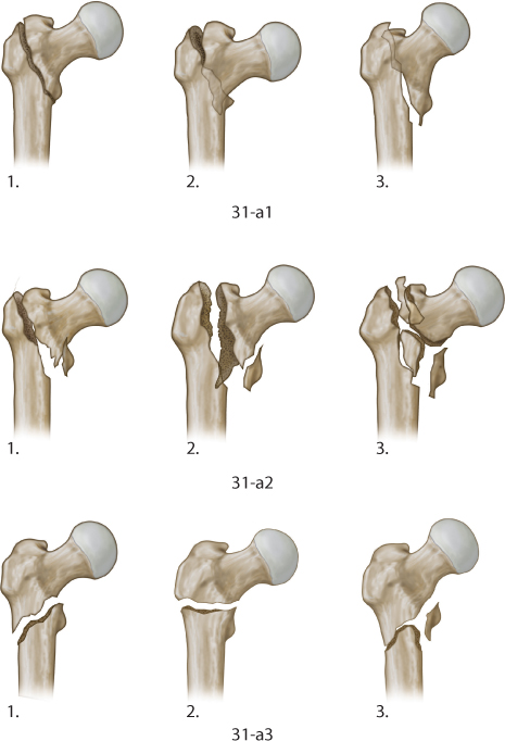 Extracapsular proximal femur fractures | Musculoskeletal Key