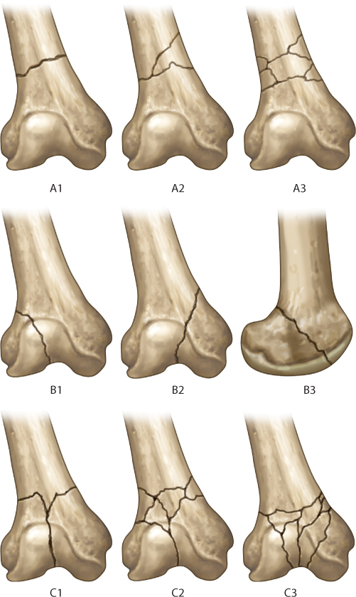 Distal Femur Fracture Classification Images And Photos Finder