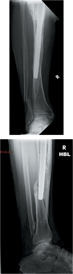 Tibia and fibula diaphyseal fractures | Musculoskeletal Key