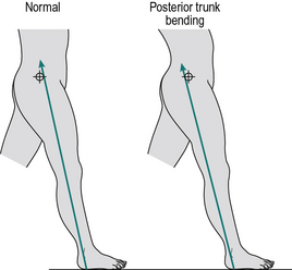 Pathological and other abnormal gaits | Musculoskeletal Key
