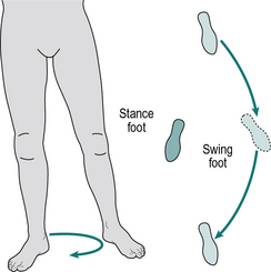 Circumduction Gait