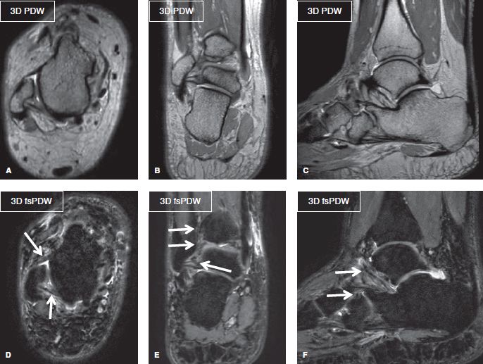 MRI oversampling, Fold-over suppression