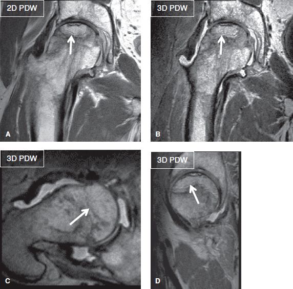 MRI oversampling, Fold-over suppression