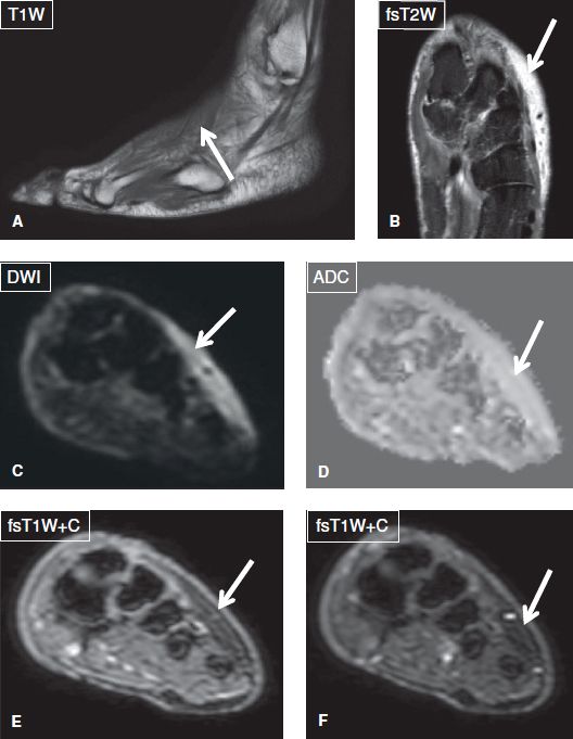 icd 10 code for lateral soft tissue swelling left ankle