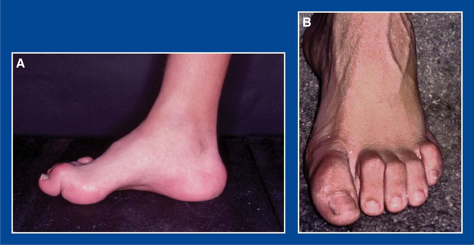 Foot And Ankle Deformities | Musculoskeletal Key