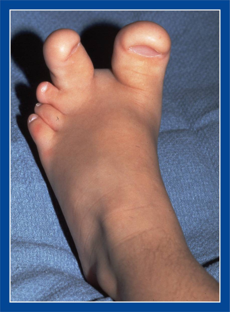 Duplication of Rt foot with indistinguishable big toe.