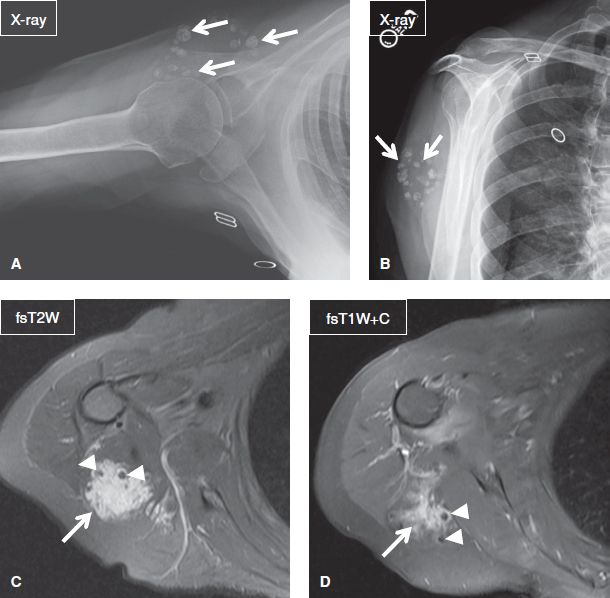 Bone And Soft Tissue Tumors Musculoskeletal Key