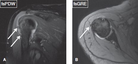 subdeltoid bursitis mri