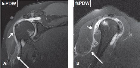 subdeltoid bursitis mri